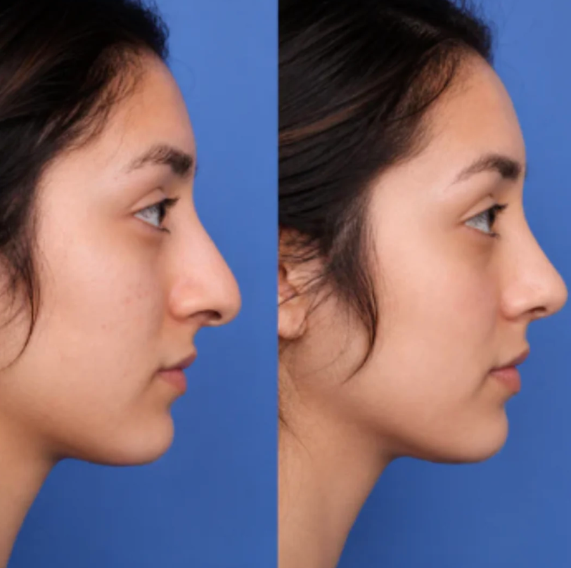 Nurela Nose Sculpt