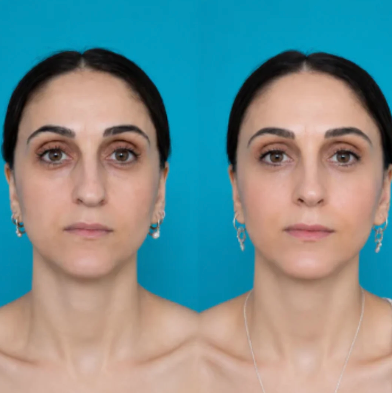 Nurela Nose Sculpt