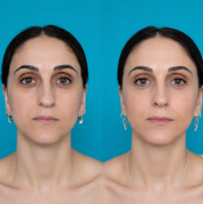 Nurela Nose Sculpt